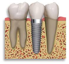 dental-implants