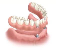 overdenture-implants